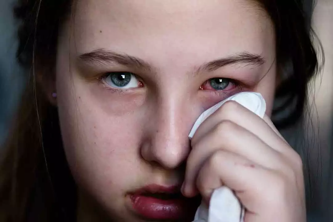 Bacterial Eye Infections and Allergies: What's the Connection?