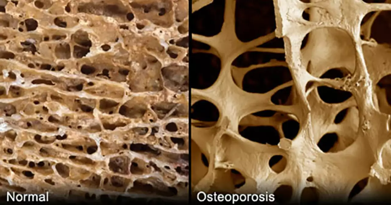The Role of Vitamin D in Bone Damage Prevention and Treatment